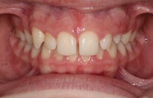 Space in teeth
