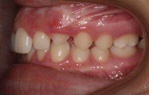 Left Side View of Teeth