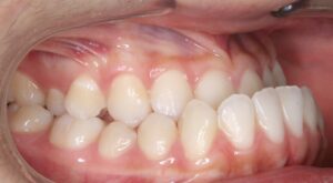 Underbite View of Teeth Edmonton Orthodontist