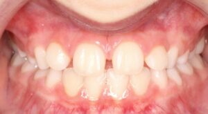 Gap in front teeth