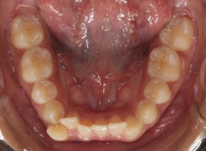 Crooked Inside Teeth