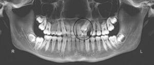 x-ray of crooked teeth