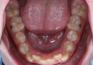 Crooked Inside Lower Teeth