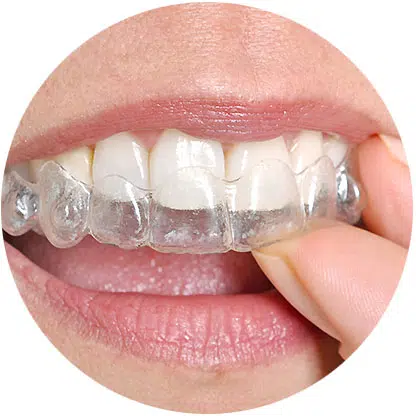 Invisalign Edmonton