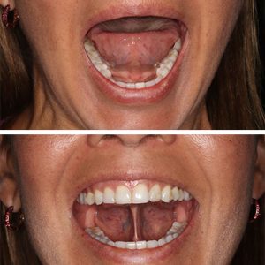 Edmonton Myofunctional Therapy Before and After