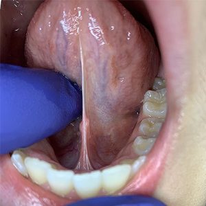 Myofunctional-Therapy